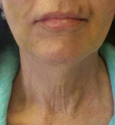 After Image: Thread Lift - front