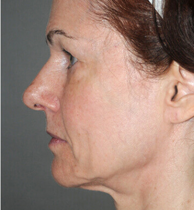 Before Image: Y-LIFT - left-side
