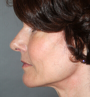 After Image: Y-LIFT - left-side