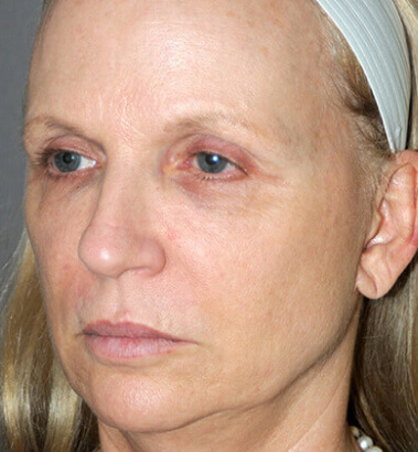 Before Image: Y-LIFT - left-front-oblique