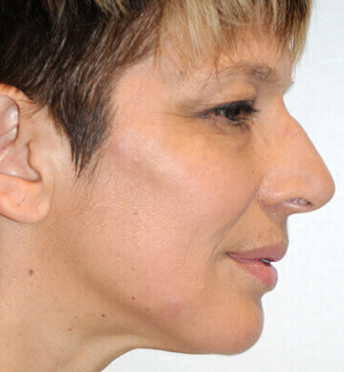 After Image: Y-LIFT - right-side