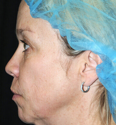 Before Image: Y-LIFT - left-side