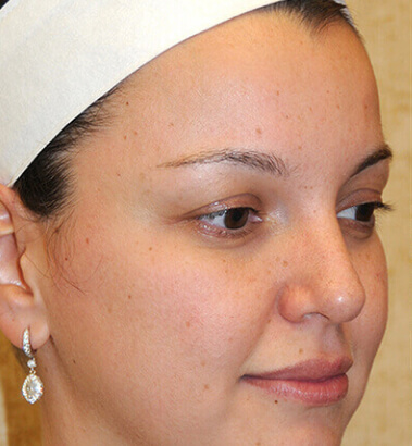 Before Image: Y-LIFT - right-front-oblique