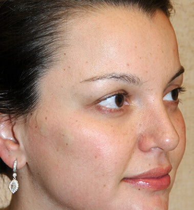 After Image: Y-LIFT - right-front-oblique