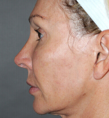 Before Image: Y-LIFT - left-side