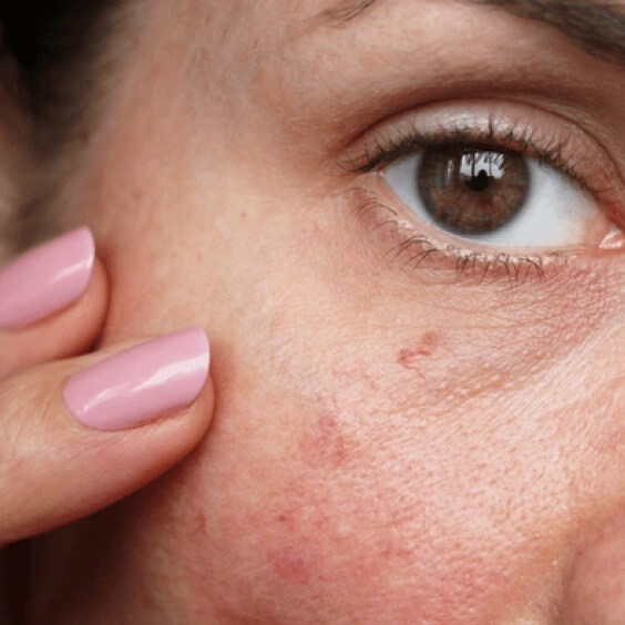 Broken Capillaries