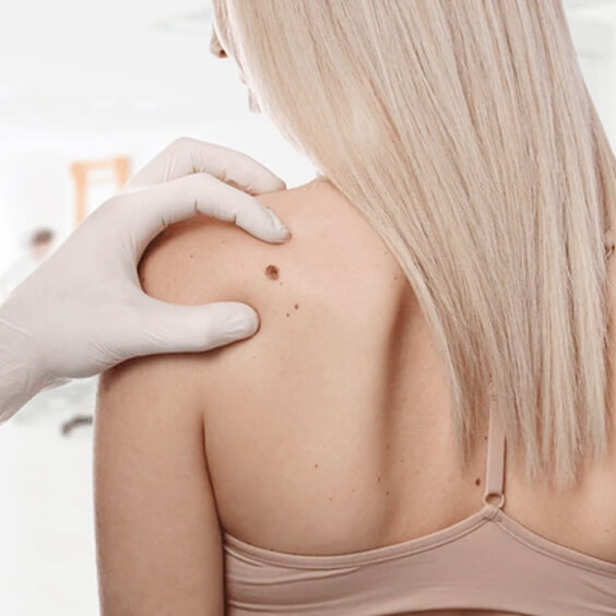 Mole Skin Tag