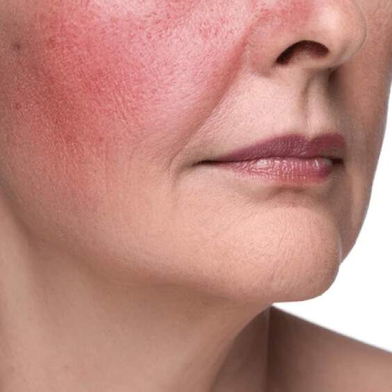Rosacea