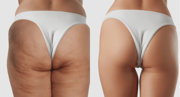 BootyLift3