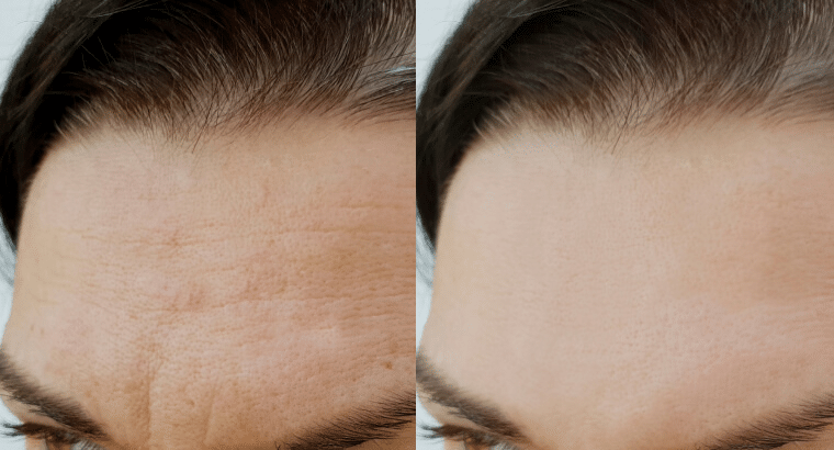 botox2
