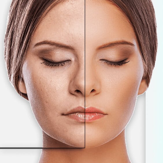 hero-fraxel-skin-resurfacing