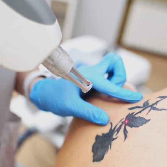 hero-laser-tattoo-removal