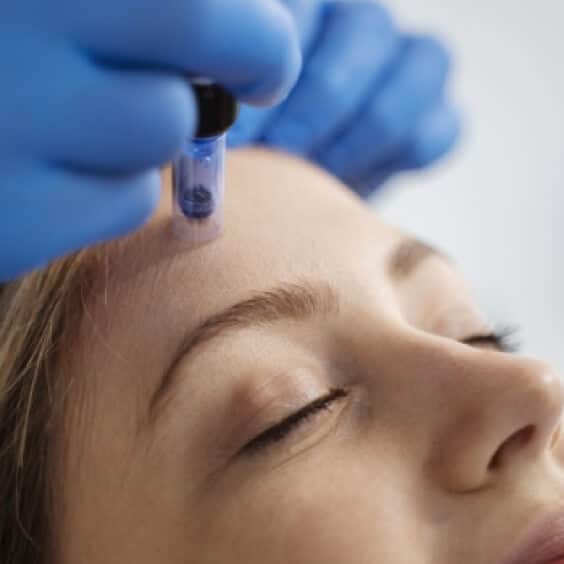 hero-skinstylus-microneedling