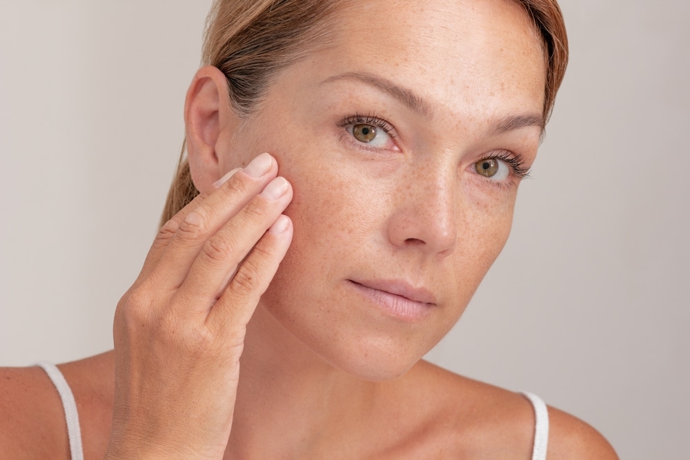 Close-up of cheek discoloration from melasma and uneven pigmentation.