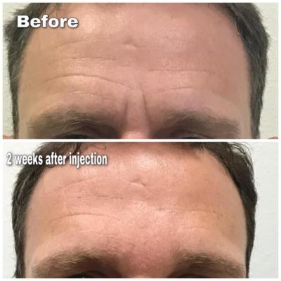 Before and 2 weeks after Juvederm Ultra XC and Xeomin to help with deep forehead lines
