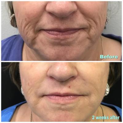 Before and 2 weeks after using 2 syringes of Radiesse Filler on the laughing lines