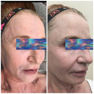 Before and After IS Clinical Champagne Facial