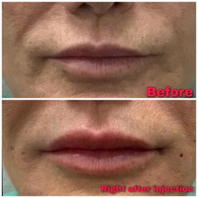 Before and After lip filler injections using Versa