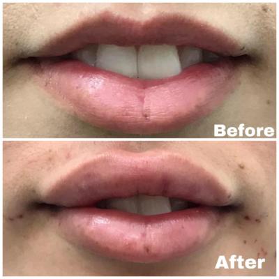Before and After lip filler using 2 ml Juvederm Ultra XC