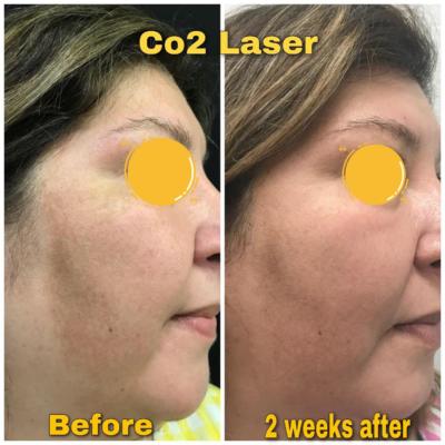 Before and After of CO2 Laser 2 weeks