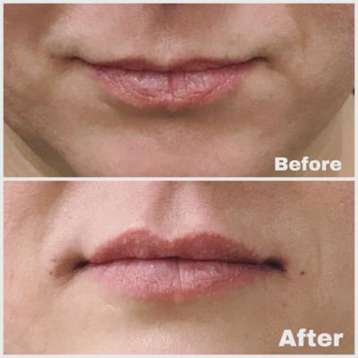 Before and After of lip filler using 1 ml Juvederm Ultra XC