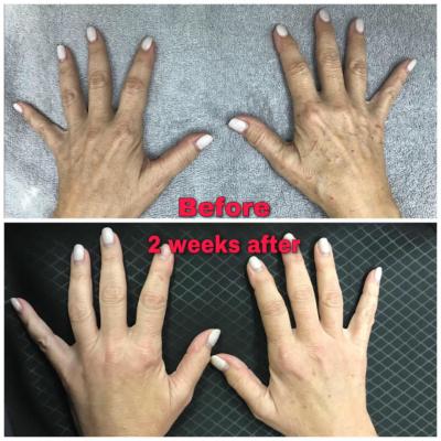 Before and After of the hands using Radiesse Filler