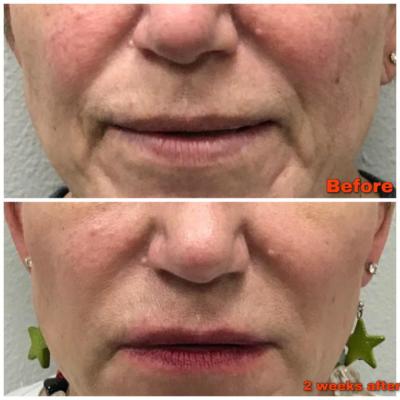 Before and After laughing lines smoothed with Radiesse Filler
