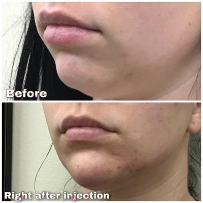 Before and After using Radiesse Filler to lift the chin and define jawline