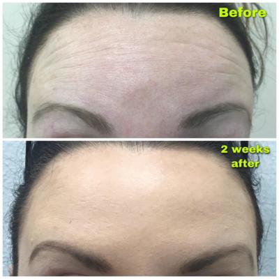 Before and After pictures of Dysport to help with fine lines and wrinkles
