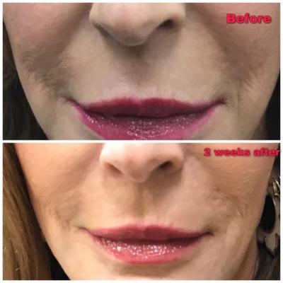 Before and After pictures of smile lines softened using Juvederm Voluma Filler