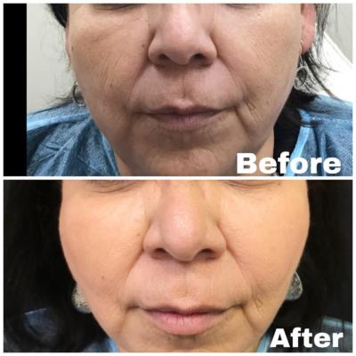 Before and After using Revanesse Versa for Cheek Enhancement Victora Tx