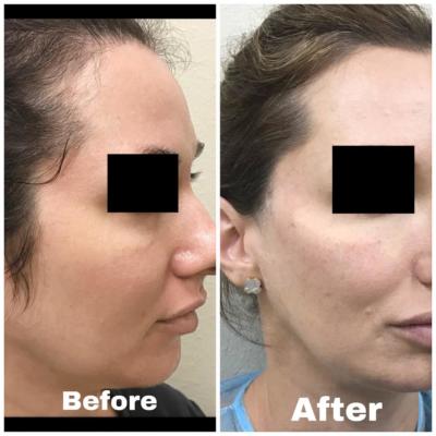 Before and After using Revanesse Versa for Cheek Enhancement
