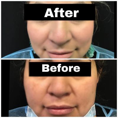 Before and After using Revanesse Versa for the Smile Lines