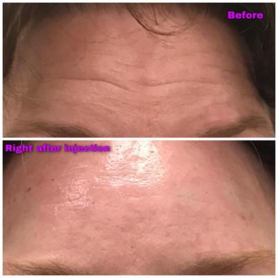 Juvederm Filler Injections for the deep forehead lines
