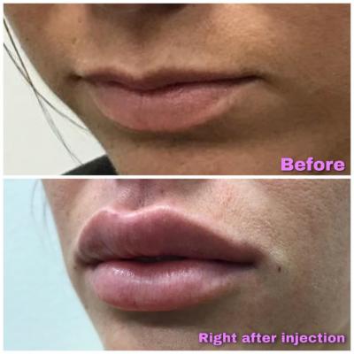 Versa Lip Filler before and after