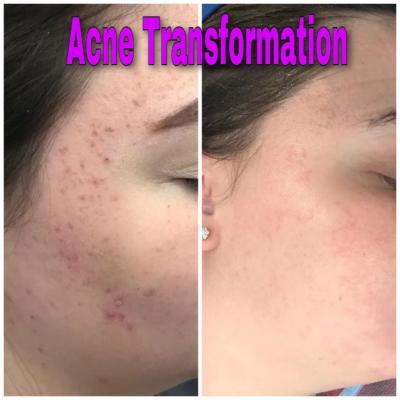 acne scarring before after images