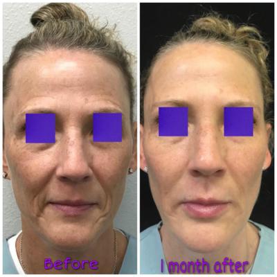 before and after 1 month Y-Lift