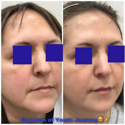 before and after Thread lift of eyebrows and jowls