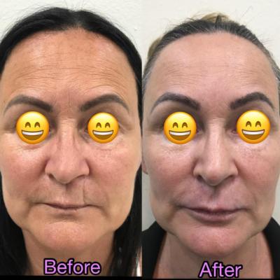 before and after the nose job and eyebrows thread lift Tx