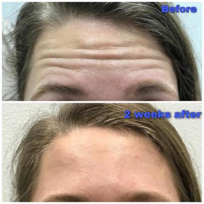 before and after the neurotoxin Jeuveau