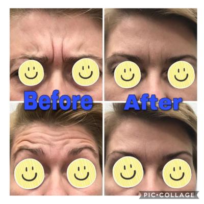 before and after results Dysport