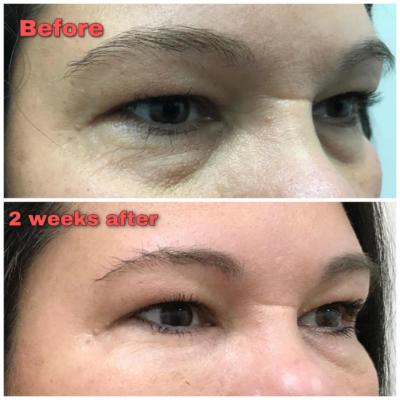 before and after Belotero Filler for the undereyes