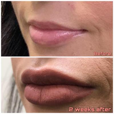 before and after lips using Juvederm Ultra Plus