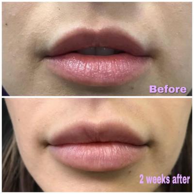 before and after versa filler treatment texas