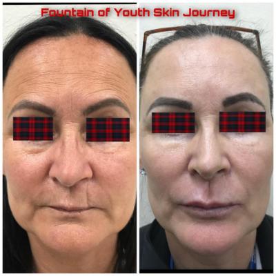 Threadlift scar revision with filler lip filler celebrity peel Tx